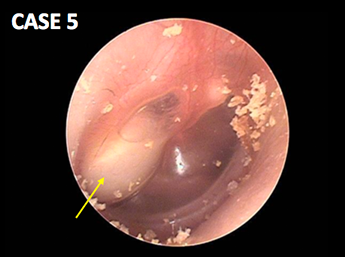 耳鼻咽喉科内藤クリニック 先天性真珠腫 3歳男児