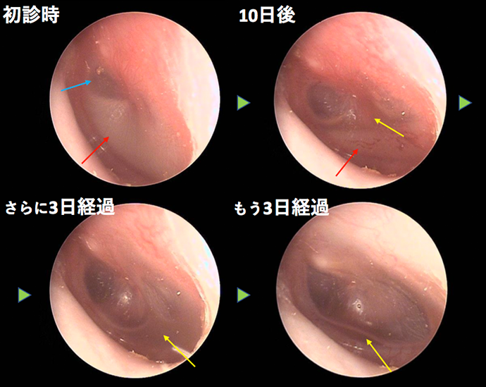 耳鼻咽喉科内藤クリニック 急性中耳炎（比較的軽症）　CASE 1