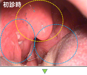 耳鼻咽喉科内藤クリニック 扁桃周囲膿瘍